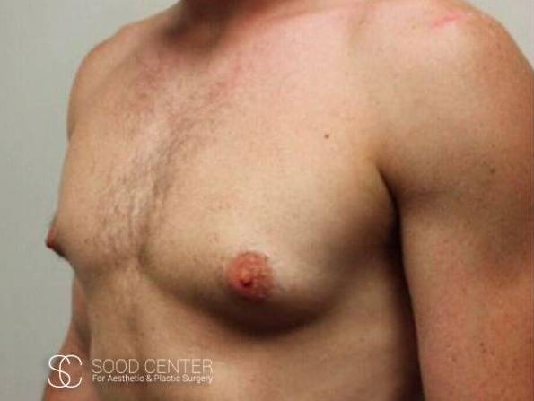 Gynecomastia Case09 Before