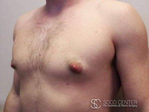 Gynecomastia Case09 After