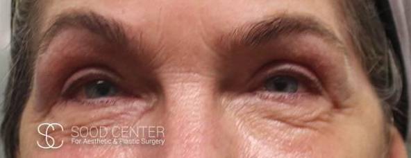 CO2 Laser Resurfacing Before and After Pictures Before