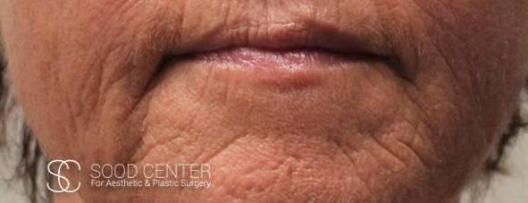 CO2 Laser Resurfacing Case 02 Before