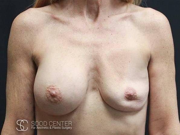 breast revision case 2 Before