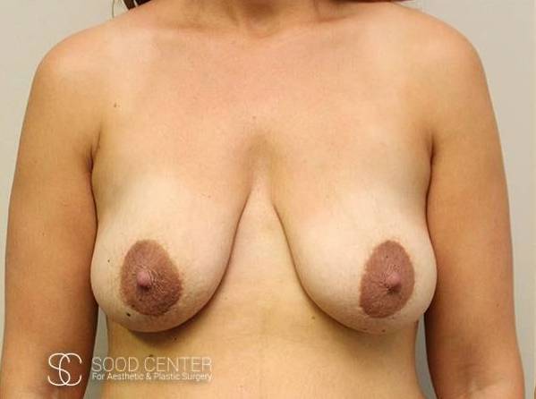 Breast Lift Case06 Before