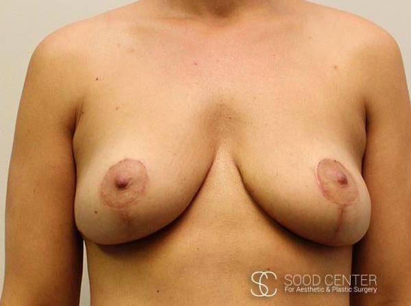 Breast Lift Case06 After