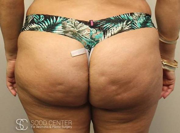 Brazilian Butt Lift Before and After Pictures Before