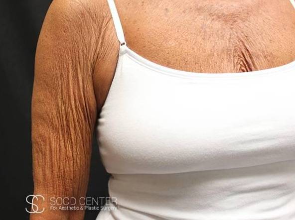 Brachioplasty Before and After Pictures - Sood Center Before