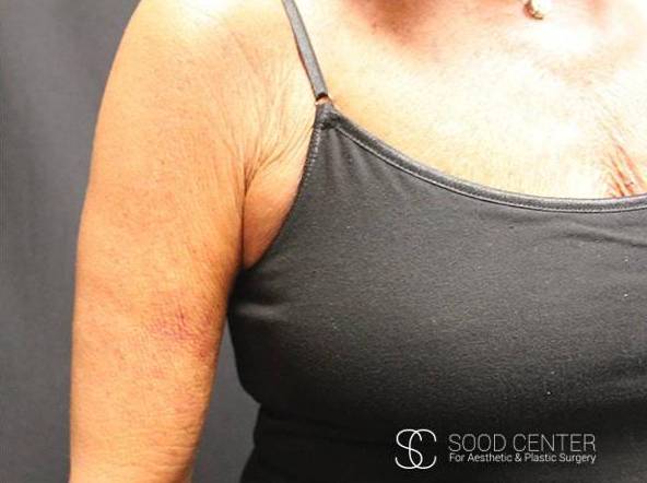 Brachioplasty Before and After Pictures - Sood Center After