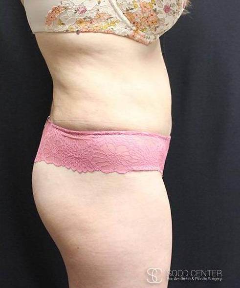 Liposuction Before and After Pictures After