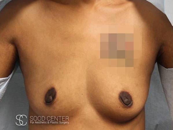Dual-Plane Breast Augmentation Before and After Pictures Before