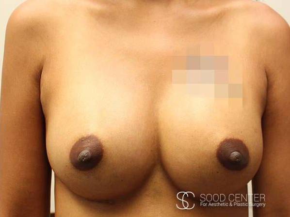 Dual-Plane Breast Augmentation Before and After Pictures After