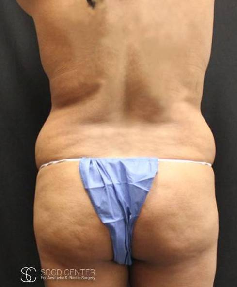 Liposuction Case 02 Before