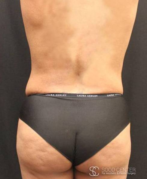 Liposuction Case 02 After