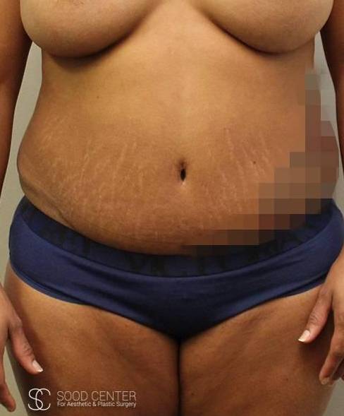 Liposuction Case 03 Before