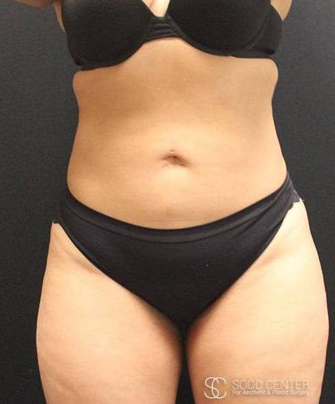 Liposuction Case 04 After