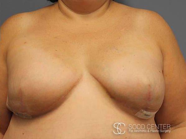 Breast Reconstruction Before and After Pictures After