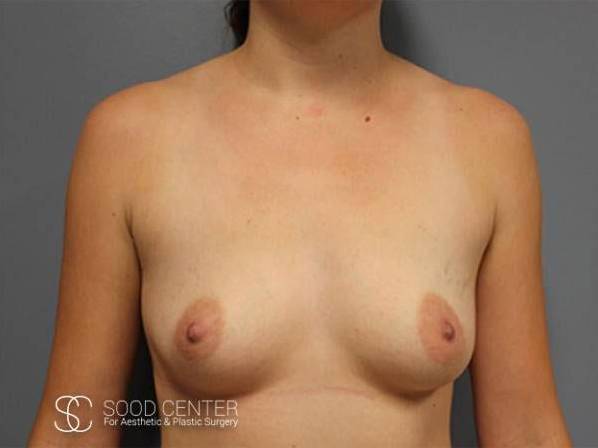 Breast Reconstruction Case 05 Before