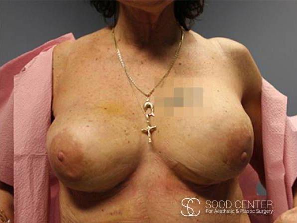 Breast Reconstruction Case 06 After