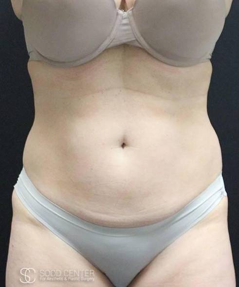 Liposuction Case 05 Before