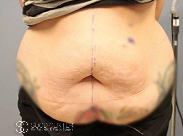 Tummy Tuck Before and After Pictures Before