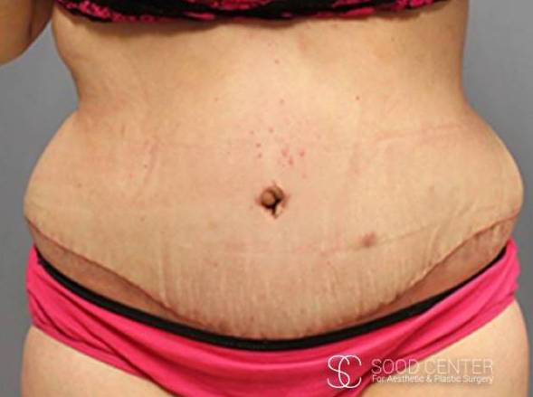 Tummy Tuck Before and After Pictures After