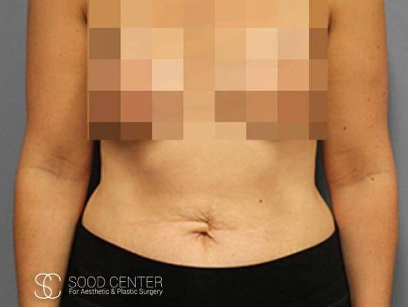 Tummy Tuck Case 02 Before