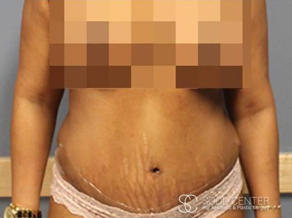 Tummy Tuck Case 03 After