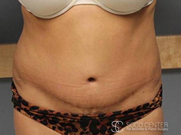 Tummy Tuck Case 04 After
