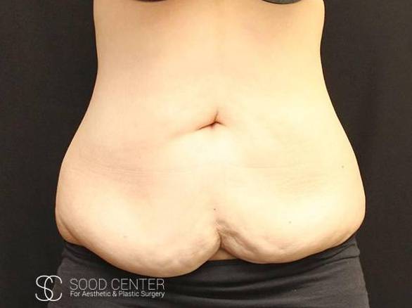 Tummy Tuck Case 05 Before