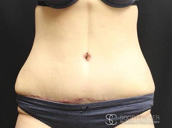 Tummy Tuck Case 05 After