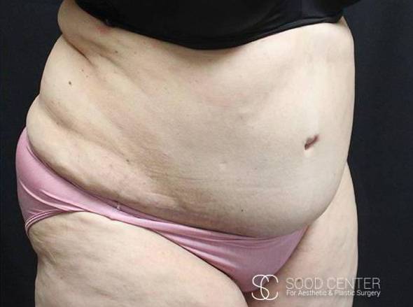 Tummy Tuck Case 06 After