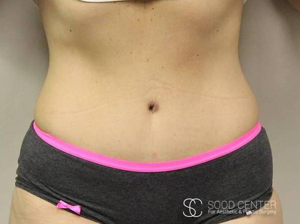 Tummy Tuck Case 07 After