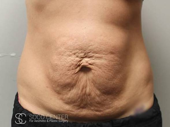 Tummy Tuck Case 08 Before