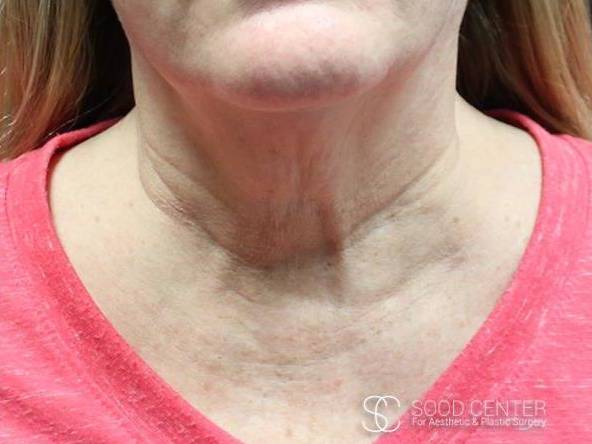 Kybella Case 02 After