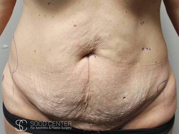 Tummy Tuck Case 09 Before