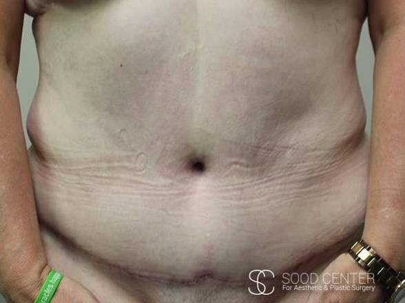 Tummy Tuck Case 10 After