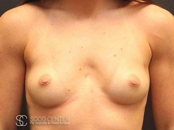 Breast Augmentation Before and After Pictures Before