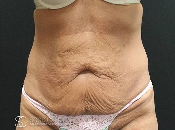 Tummy Tuck Case 11 Before