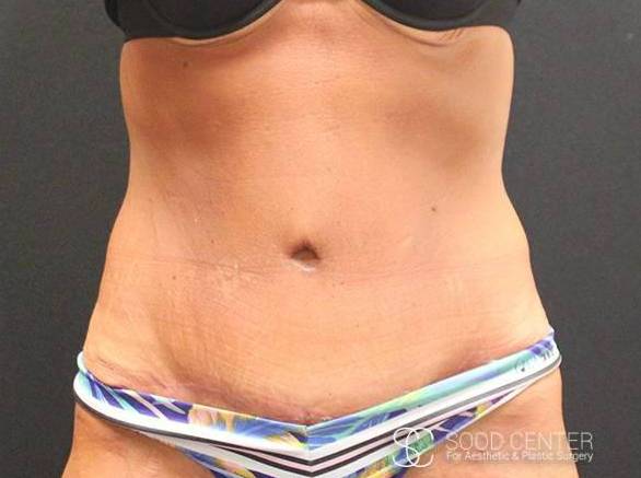 Tummy Tuck Case 11 After