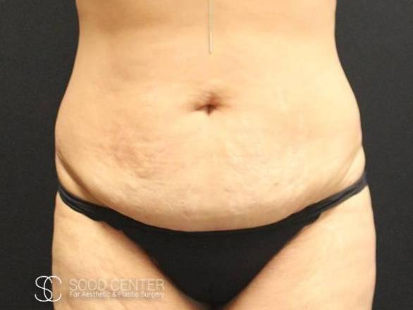 Tummy Tuck Case 12 Before