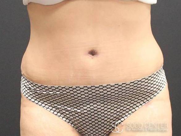 Tummy Tuck Case 12 After