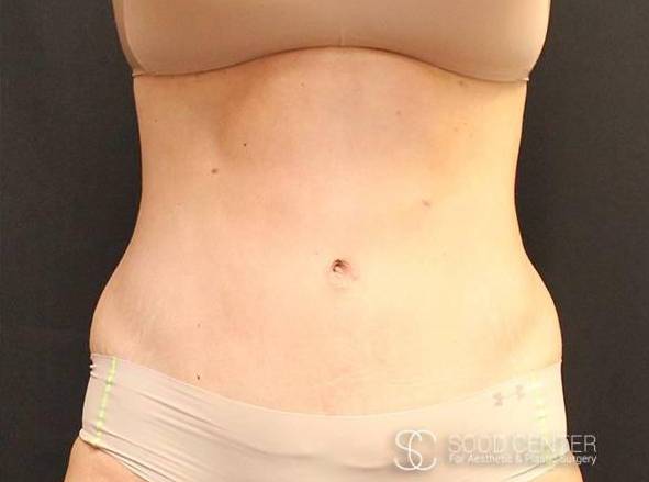 Tummy Tuck Case 14 After