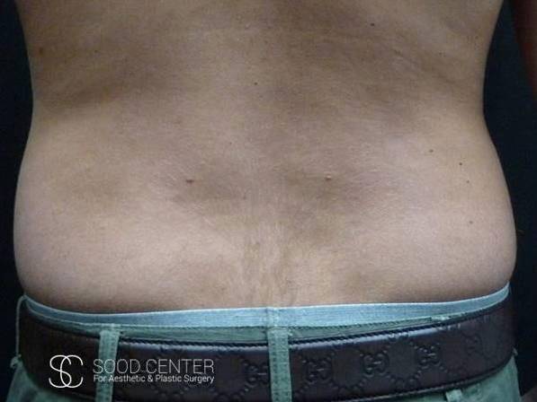 Coolsculpting Before and After Pictures Before