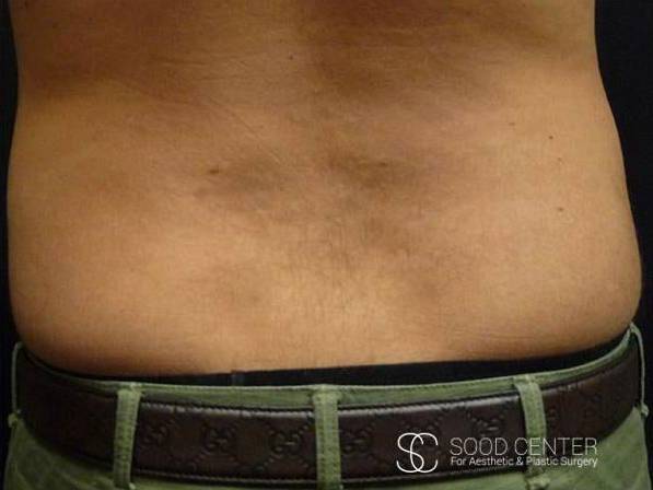 Coolsculpting Before and After Pictures After