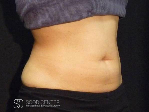 Coolsculpting Case 03 Before