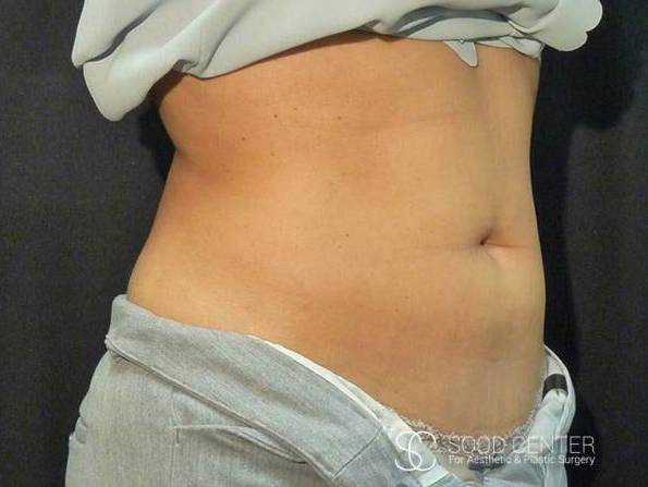 Coolsculpting Case 03 After