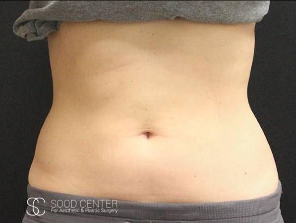 Coolsculpting Case04 Before