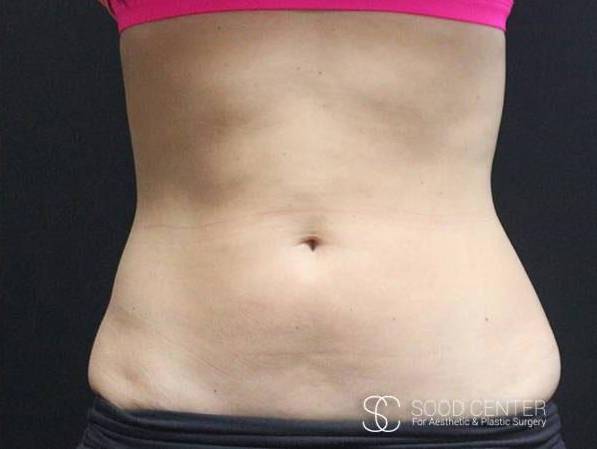 Coolsculpting Case04 After