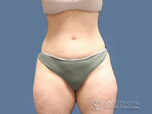 Coolsculpting Case05 After