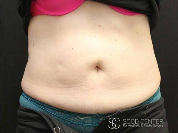 Coolsculpting Case06 After