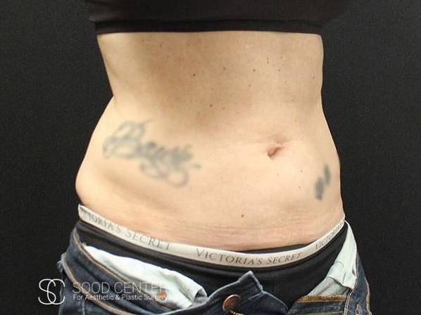 Coolsculpting Case09 Before