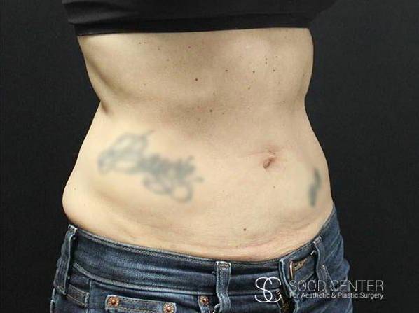 Coolsculpting Case09 After